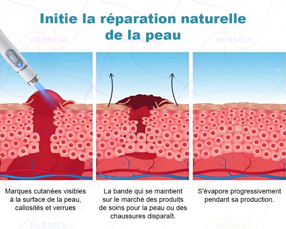 pointeur laser non-invasif - élimination des grains de beauté et des verrues (🔥Dernier jour 80% de réduction)