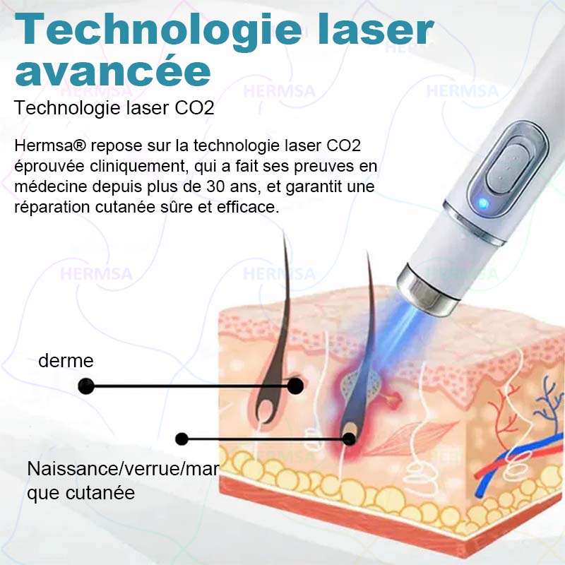 pointeur laser non-invasif - élimination des grains de beauté et des verrues (🔥Dernier jour 80% de réduction)