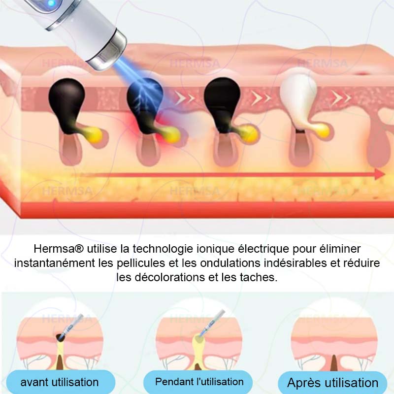 pointeur laser non-invasif - élimination des grains de beauté et des verrues (🔥Dernier jour 80% de réduction)