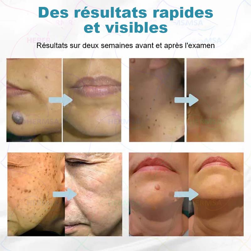 pointeur laser non-invasif - élimination des grains de beauté et des verrues (🔥Dernier jour 80% de réduction)